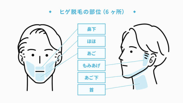 ヒゲ脱毛6部位の施術箇所について