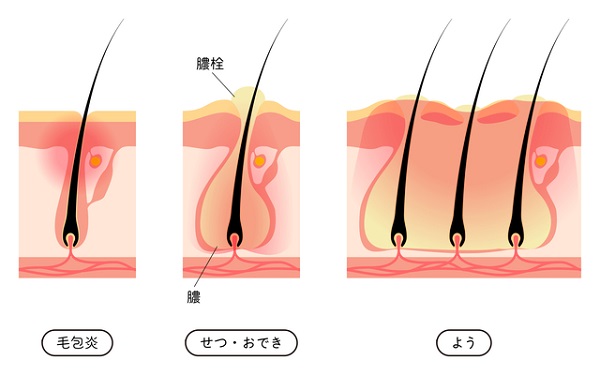 毛嚢炎が悪化して「せつ」や「よう」になる過程