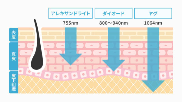 ダイオードレーザー、アレキサンドライトレーザー、ヤグレーザーそれぞれの違い