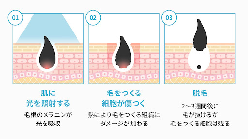 光脱毛の仕組みに関する画像