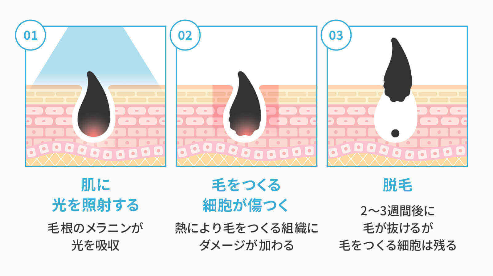 光脱毛の仕組みに関する画像