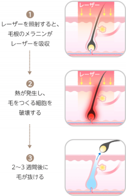 医療レーザー脱毛の仕組み