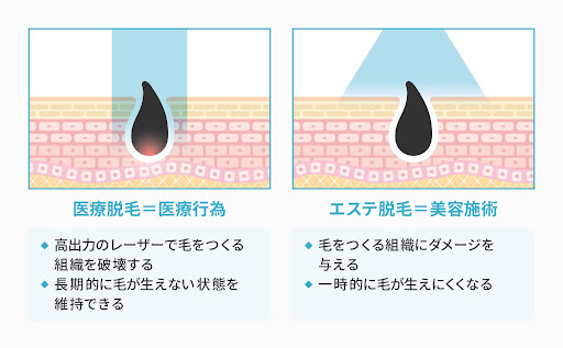 医療脱毛とIPL（エステ）脱毛の違い